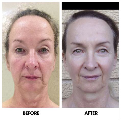 face yoga before and after reddit|I Tried Face Yoga for 3 Weeks. Here's How It Changed My Face.